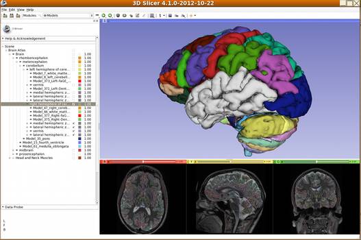 3D Slicer view of brain
